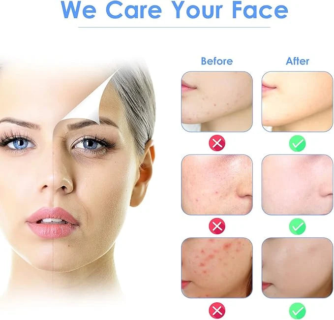 Before and after skin comparison showing acne reduction and clearer complexion.